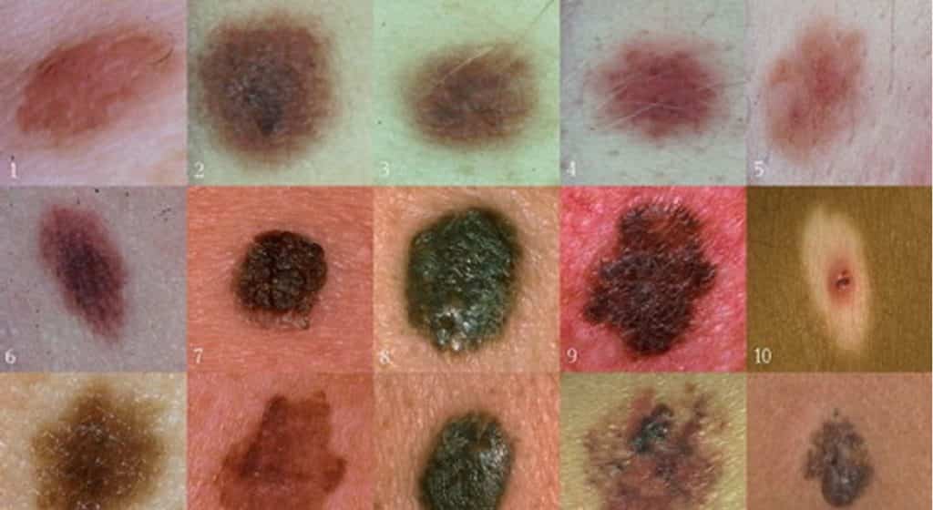 Neo sporgente, in rilievo o ingrossato è benigno o maligno?