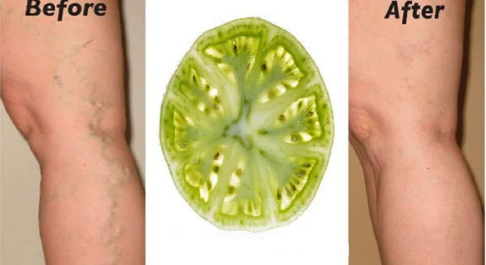 Pomodori verdi sulle vene varicose