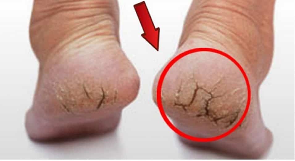 talloni doloranti, duri, screpolati, secchi, rovinati, spaccati