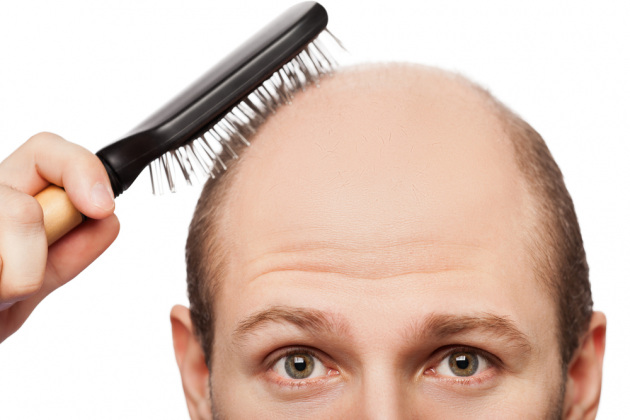 la perdita di capelli non è sempre dovuta ad un fattore genetico ecco le cause