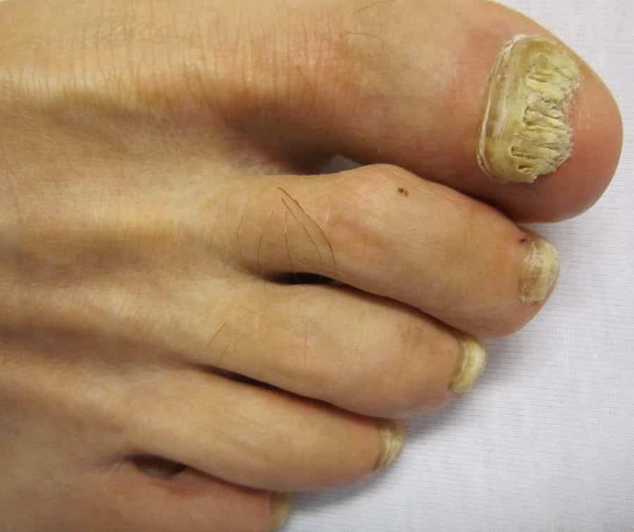 Micosi sulle unghie dei piedi