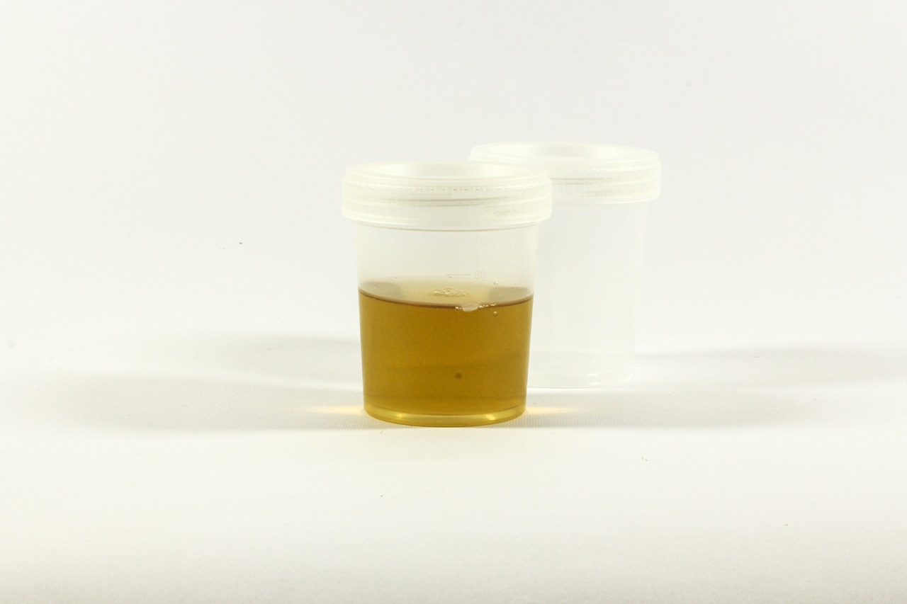 urina maleodorante, le cause della pipì che puzza