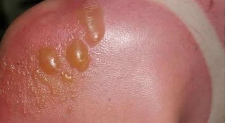 Bolle da scottatura solare, vesciche da ustione