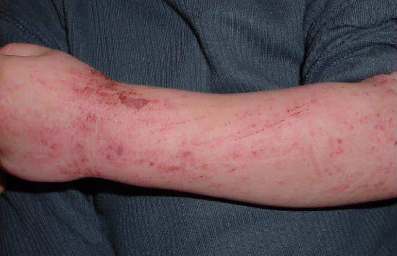 Aglio ed Eczema dermatite atopica