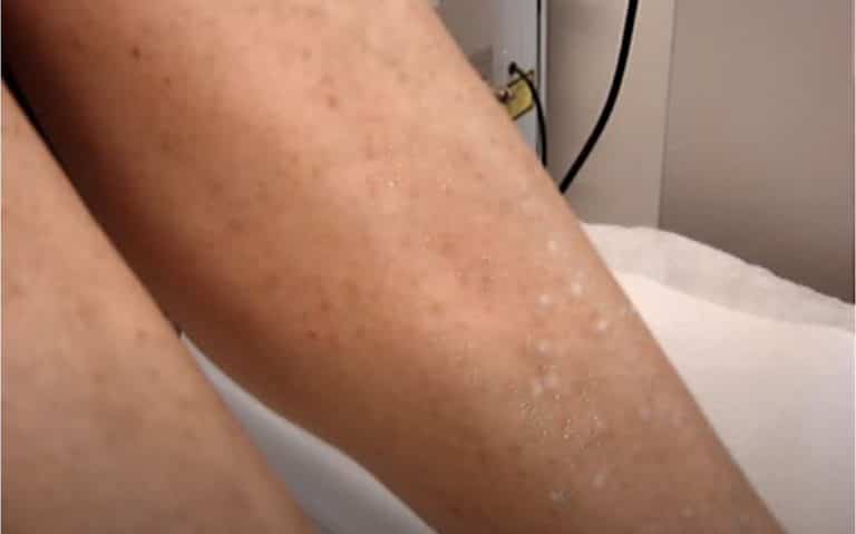 Macchie Bianche Sulle Gambe Dopo L abbronzatura Cause E Rimedi